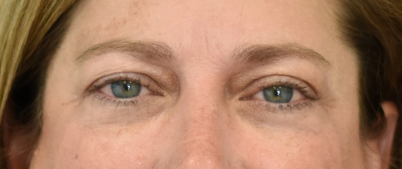 Eyelid Surgery Patient 12 Set 1 After