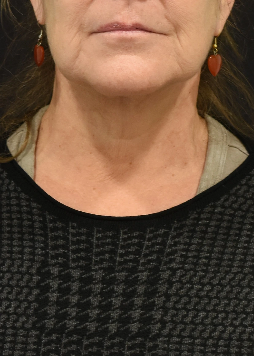 Neck Lift Patient 32 Set 1 After