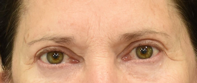Brow Lift Patient 13 Set 1 Before
