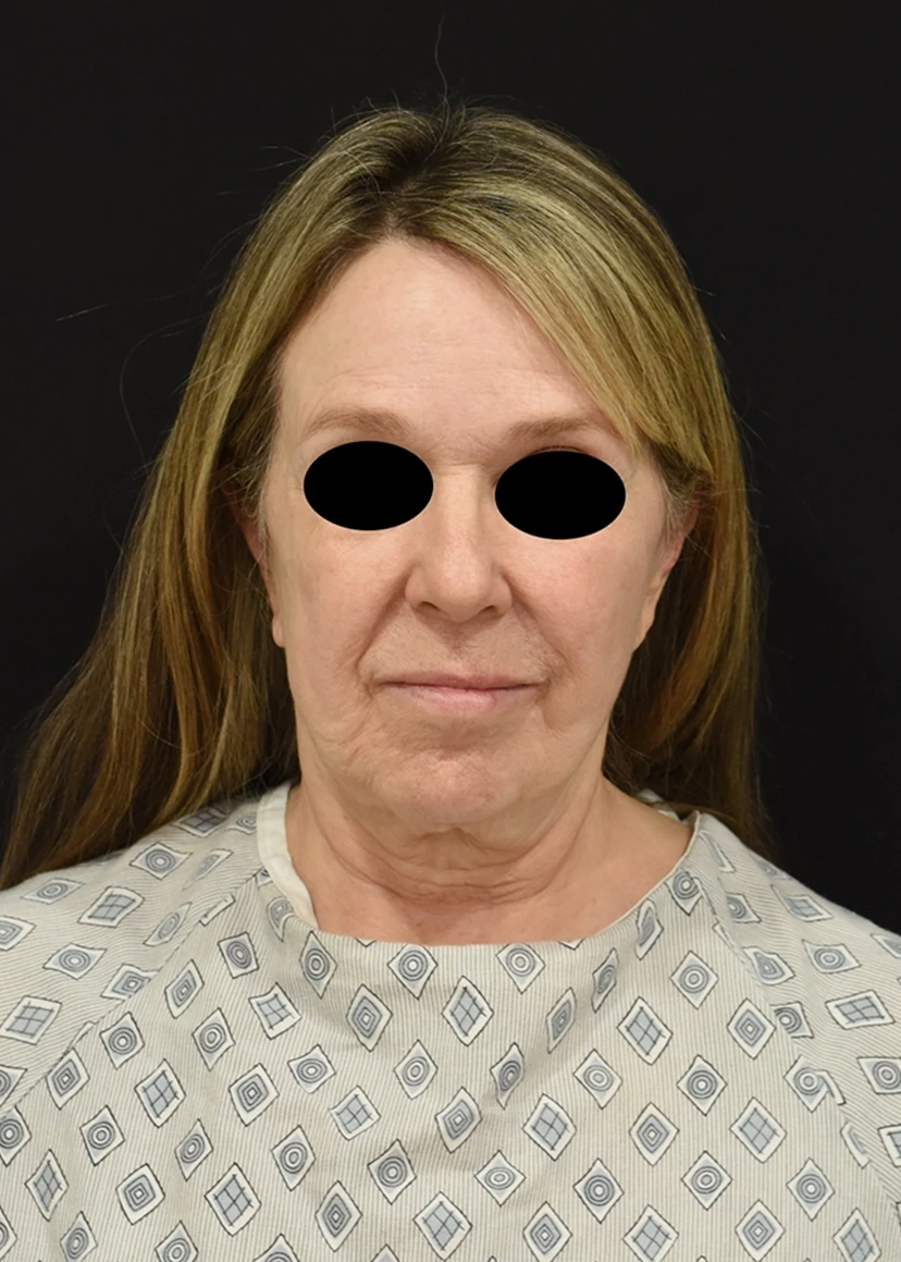 Deep Plane Facelift Patient 15 Set 1 Before